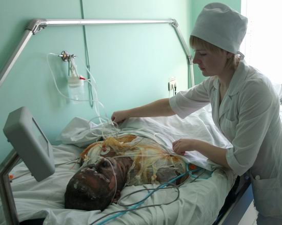 Уход за больным с ожогами Уход за больным с ожогами
