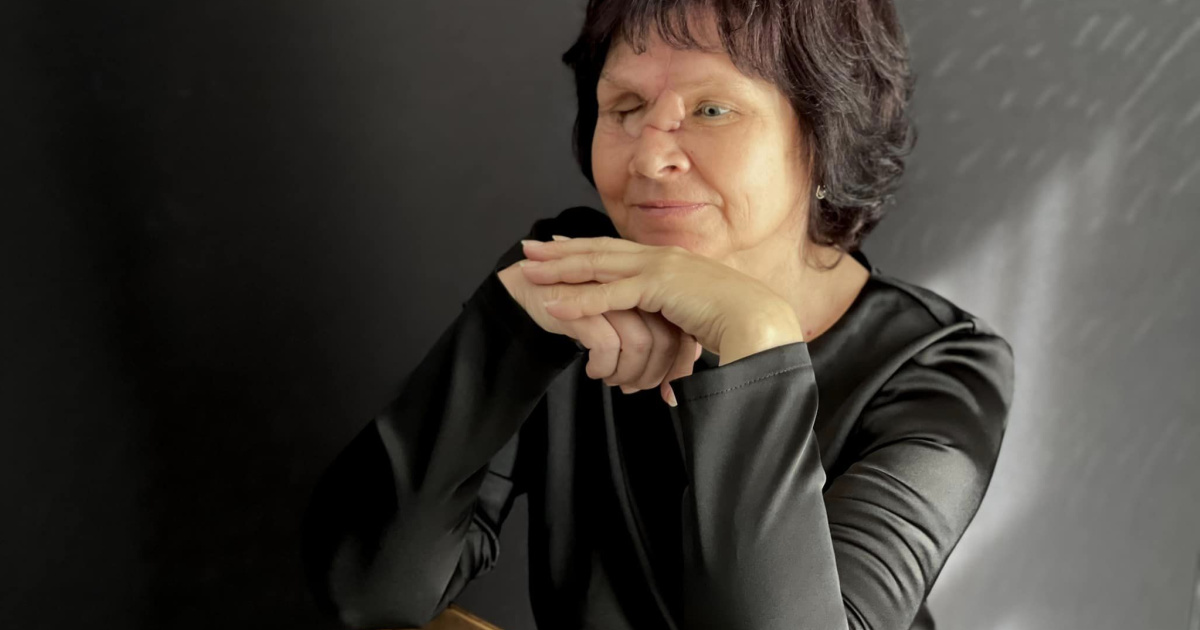 Поранена 59-річна мешканка Лисичанська стала обличчям проєкту "Незламна краса"